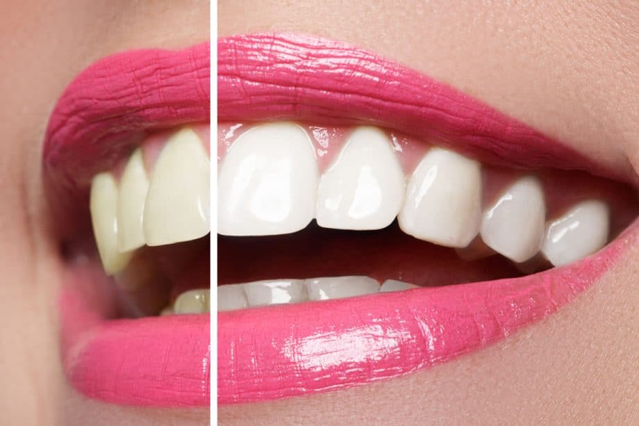 a closeup of a mouth before and after teeth whitening